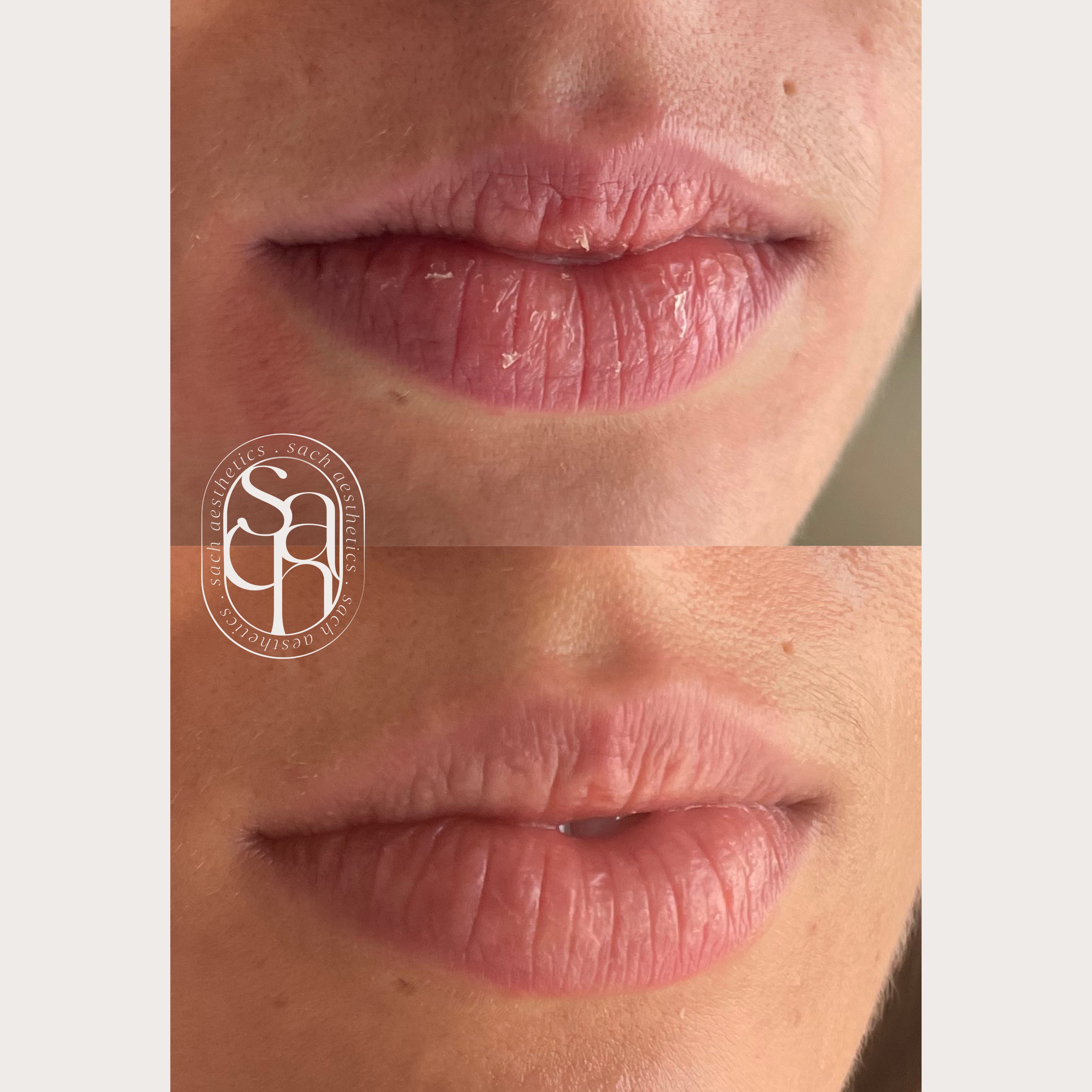 Lip enhancement with restylane lip filler on already voluminous lips.