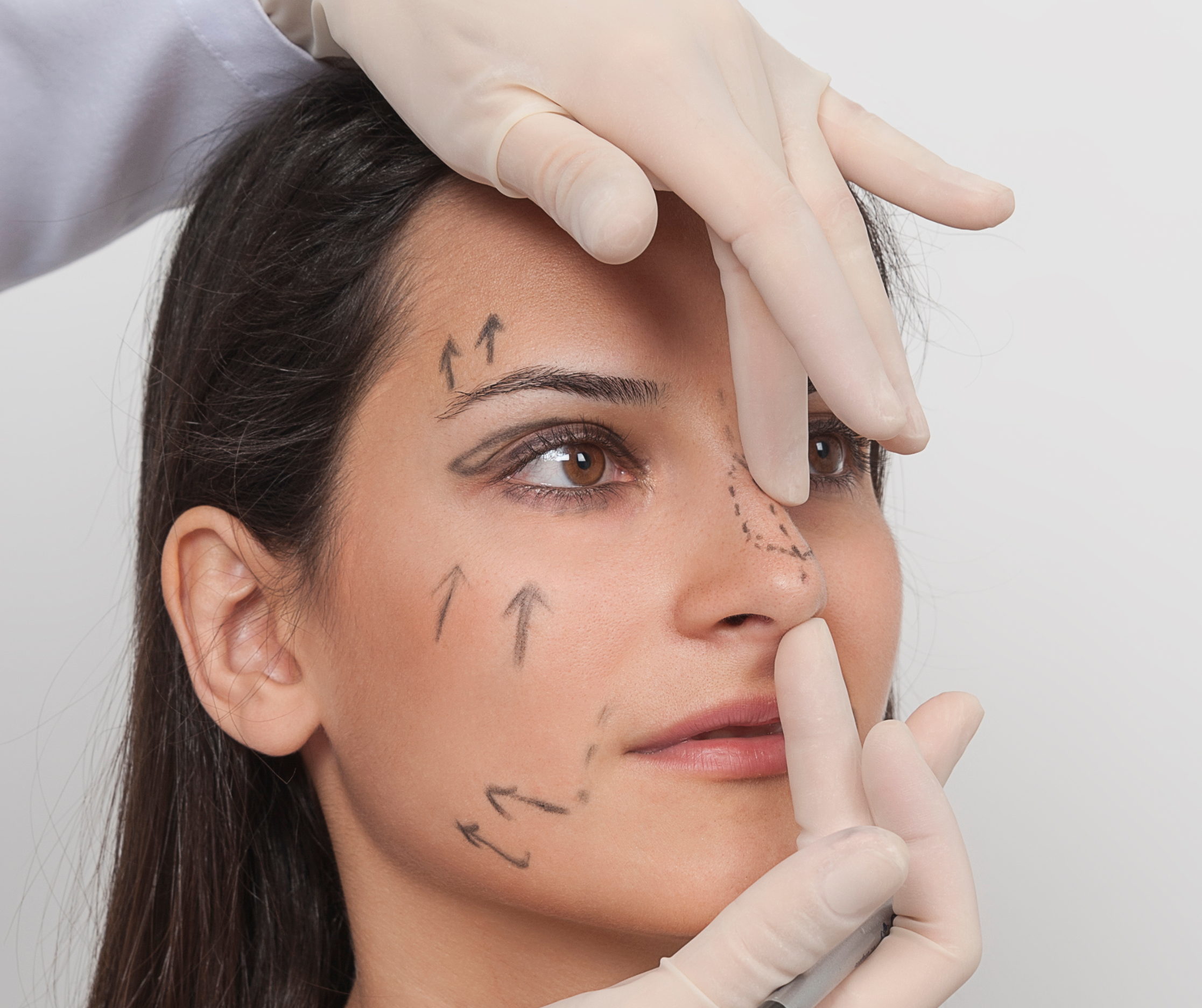 Young female with plastic surgery marking for surgical consultation